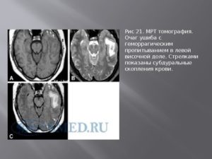 Единичный очаг левой височной доли