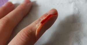Высох палец после раны