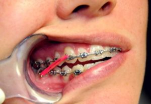 Можно ли подтянуть коренные зубы брэкетами?