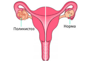 Можно ли заниматься спортом с кистой яичника