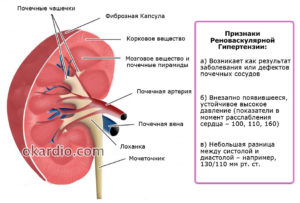 Влияние камней в почках на артериальное давление