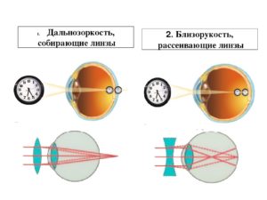 Можно ли при миопии носить линзы