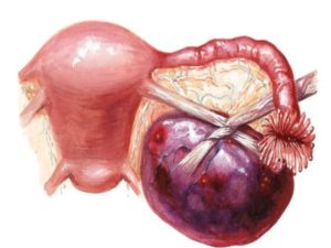 Воспаление яичников и кистозные яичники