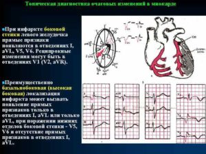 ЭКГ - изменение миокарда, снижение кровоснабжения в передне-септальной области. Опасно?