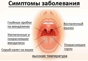 Воспаление языка и боли в горле