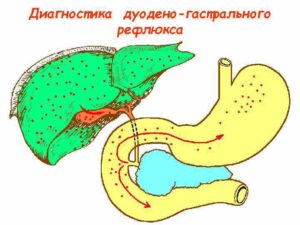 ДГР, прокинетики не действуют