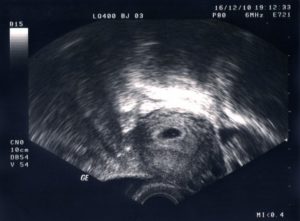 Эндометрий на 9 день после аборта