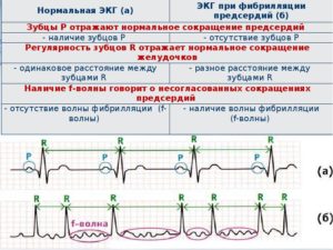 Мерцательная аритмия: пароксизмальная форма фибриляции предсердий-Эгилок или Беталок Зок?