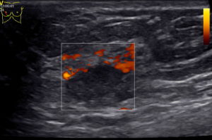 Может ли УЗИ не увидеть фиброаденому?