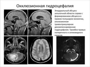 МР картина умеренно выраженной наружной гидроцефалии и точечная боль справа