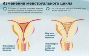 Восстановление менструального цикла после операции
