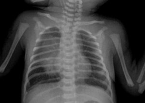 Частые рентгены органов грудной клетки ребёнку в 2 года