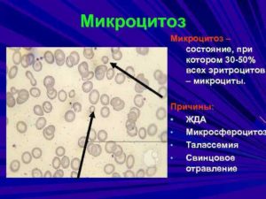 Микроцитоз + у ребенка, чем это опасно