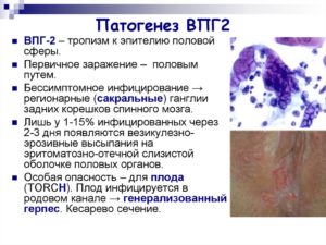 ВПГ 2 типа при беременности