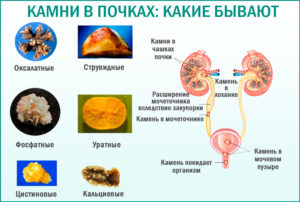 В почке камень 4 мм, можно заниматься в трен. Зале?