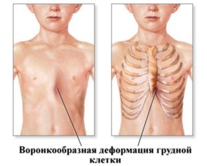 Деформация грудной клетки является преградой для поступления в военный ВУЗ?