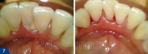 Воспаление десны после использования зубочистки
