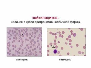 Эхиноциты в крови у ребенка 7 лет
