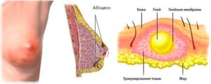 Воспаление вокруг сосков