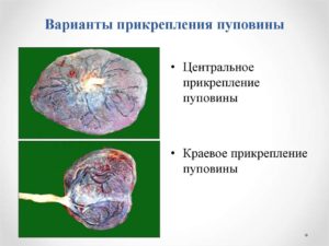 Краевое прекрепление пупочного канатика?