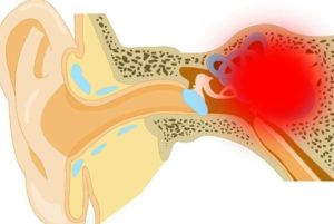 Воспаление среднего уха