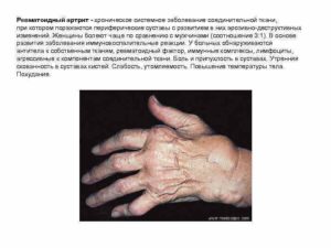 Диагноз смешанное заболевание соединительной ткани, синдром Шарпа(ревматоидный артрит