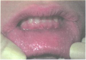 Внутренная часть губ