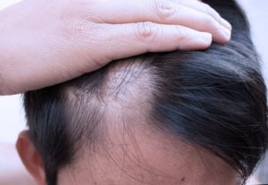Диагноз дисбактериоз, сильное выпадение волос