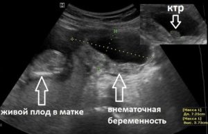 Возможно ли забеременеть при таких показателях узи