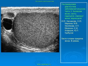 Узи органов мошонки: анэхогенные образования