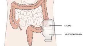 Диарея из толстого кишечника при введении колостомы