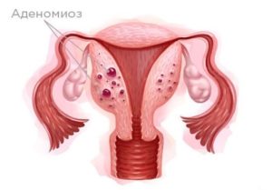 Мелоксикам при аденомикоза и очень обильных месячных