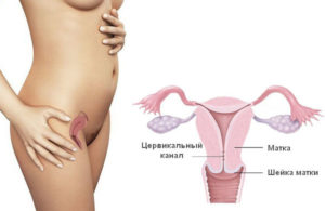 Можно ли забеременеть при сужении цервикального канала