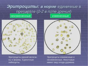 Высокая температура и эритроциты в моче