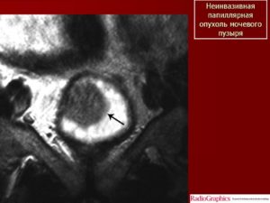 Может ли МРТ не показать опухоль мочевого пузыря