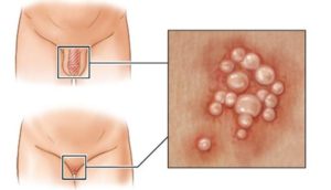 Водянистые прыщи на половой губе, натерла половые губы