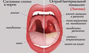 На языке постоянно налет и при простуде часто болит горло