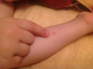 Водянистые пузыри на ручках и ножках у ребенка