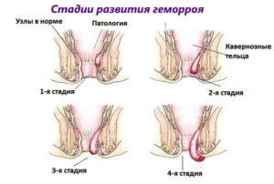 Выпуклость и потемнение вокруг ануса