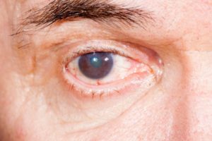 Возрастное слезотечение глаукома