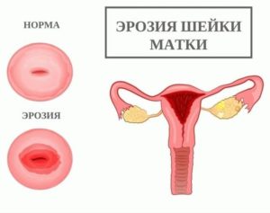 Мешает ли эрозия шейки матки забеременеть?