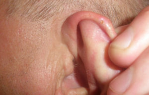 Воспаление мочки уха