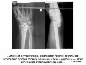 Экстензионный перелом дистального метаэпифиза лучевой кости со смещением