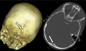 Деформация черепа чуть выше височной кости, начались головные боли