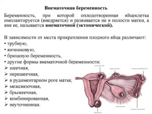 Возможность внематочной беременности