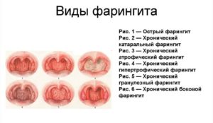 Вторичный хронический фарингит