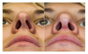 Давление после операции по исправлению перегородке носа повышенное. Что это?