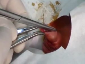 Воспаление после обрезания крайней плоти