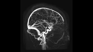 МРТ головного мозга (МР сигнал от аденогипофиза изменен)