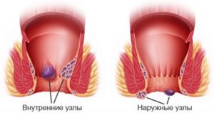 Выпадение геморроидального узла после секса/спорта?